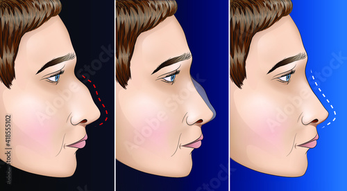 Comparison of the nose structure after surgery or cosmetic procedure
