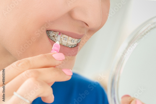 Wearing orthodontal dental brackets device mounted on woman face smile in order to align teeth photo