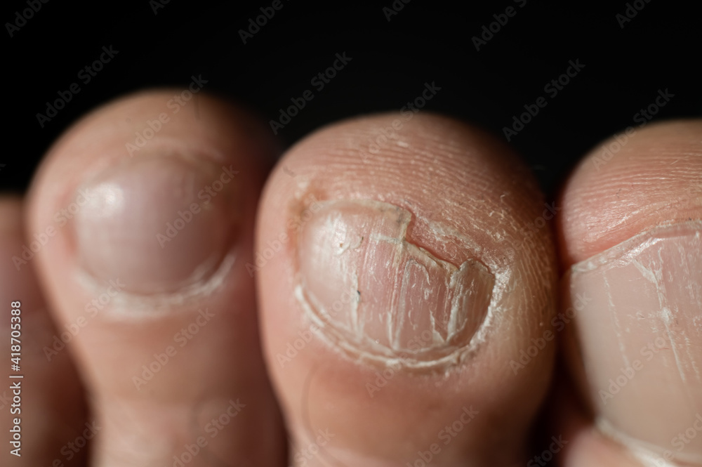 Close-up of male toes with a cracked nail Close-up of male toes with a cracked nail