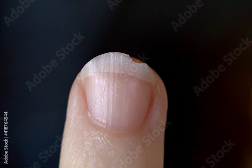 Broken Fingernail in need of a Manicure