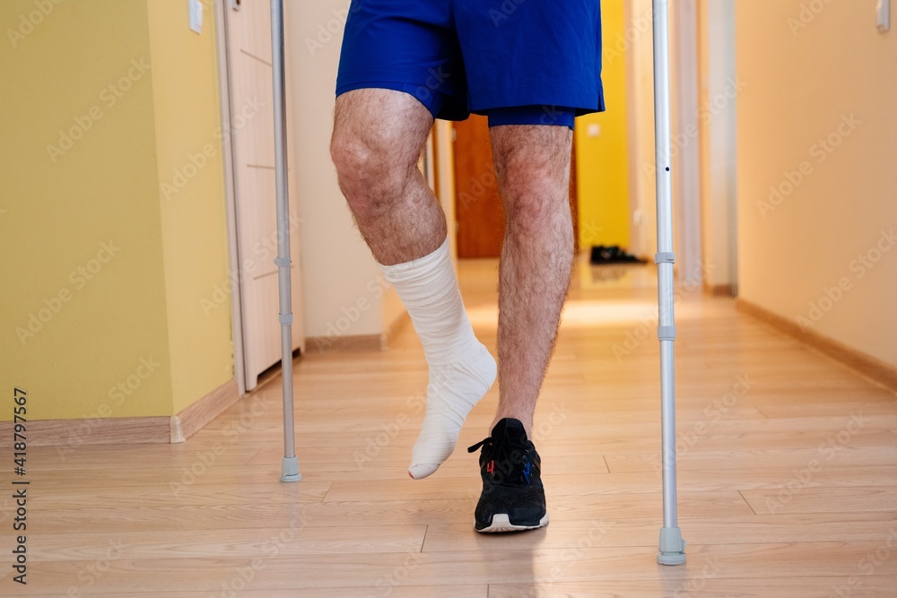 Athlete's leg in a plaster cast. Post-injury rehabilitation. Achilles tendon treatment.