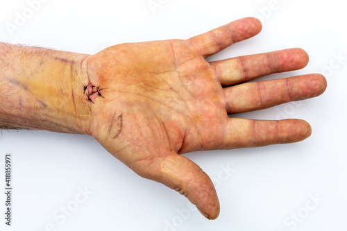 Handgelenk eines männlichen Unterarms nach einer Karpaltunnel Operation