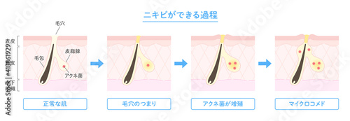 肌断面図で見せるニキビができる過程のイラスト photo