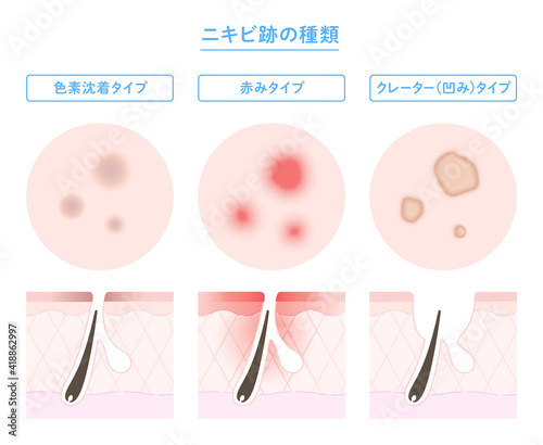 ニキビ跡の種類と肌断面図のイラスト