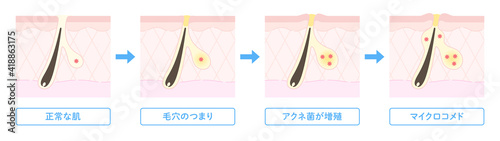 肌断面図で見せるニキビができる過程のイラスト