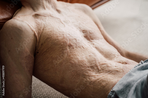 Man with a large scar after burn on the body laying at the floor and relaxing #418897919