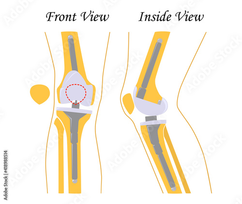 Knee replacement. Joint prosthetics. Knee endoprosthesis. Vector illustration. Flat design photo