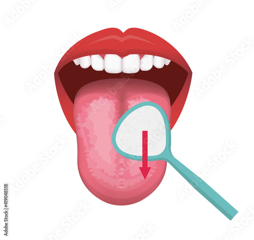 Tongue cleaning vector illustration (Halitosis prevention)