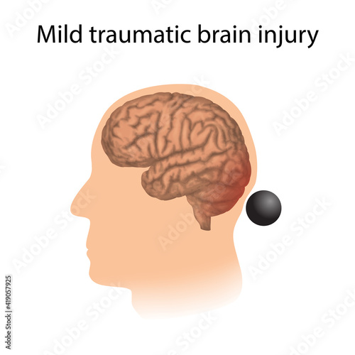 TBI. Mild traumatic brain injury. Head damage.