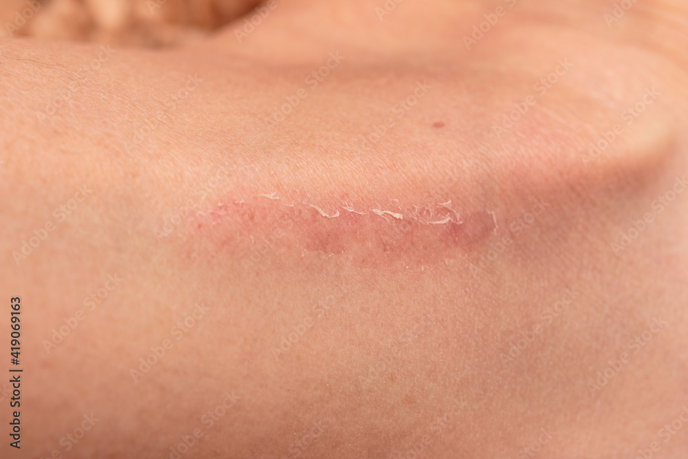 Fototapeta premium scratch on the skin of the leg as a background