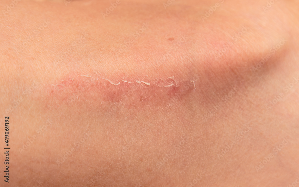 scratch on the skin of the leg as a background scratch on the skin of the leg as a background