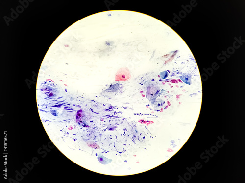 Abnormal squamous epithelial cells view in microscopy.HPV criteria for pap smear slide cytology.Koilocyte cells.Medical background. photo