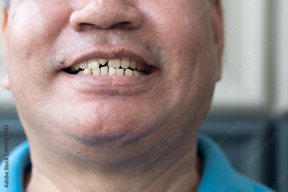 Obraz premium old man woth crooked teeth, concept of oral health care, tooth cavity