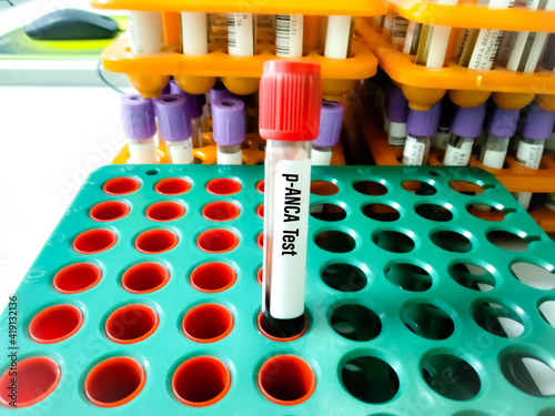 Liver figure, test tubes with blood, liver function test result are near inscription Alkaline Phosphatase ALP. Value of Alkaline Phosphatase as lab indicator in biochemistry, its levels and functions. photo