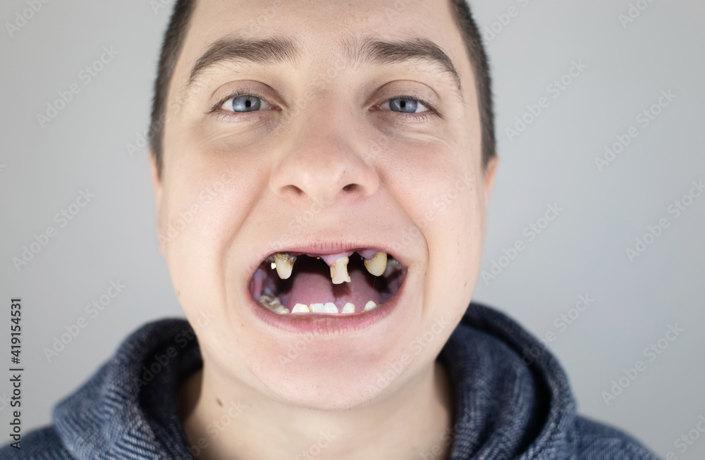 The man has rotten teeth, teeth fell out, yellow and black teeth hurt