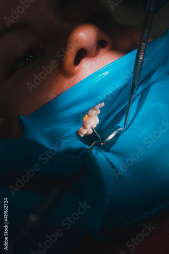 Close-up of the patient's mouth after filling the teeth with white composite resin on the insulation of a rubber dam, rubber dam and dental mirror. photo