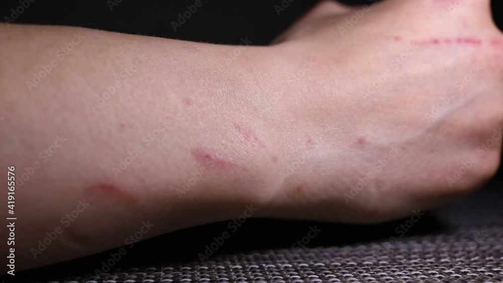 Close-up of scratch marks on a woman hand, fresh cat scratches, damaged skin Close-up of scratch marks on a woman hand, fresh cat scratches, damaged skin