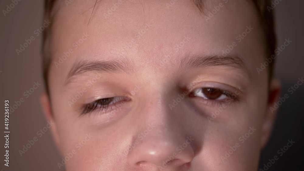 Boy with Drooping Upper of Eyelid, Long Lashes. Myopia. Opening and Close Eyes Boy with Drooping Upper of Eyelid, Long Lashes. Myopia. Opening and Close Eyes
