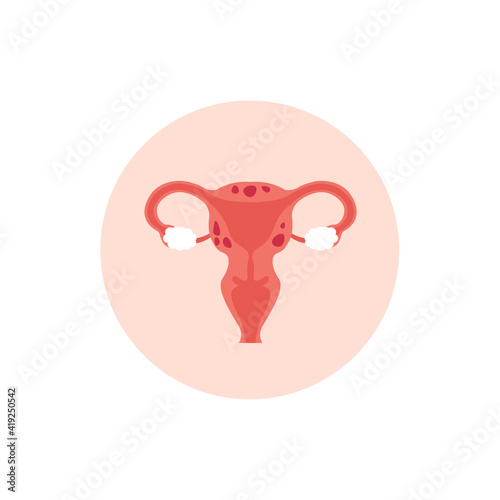 Female reproductive system with adenomyosis, enlarged uterus icon. Flat vector cartoon modern illustration. 