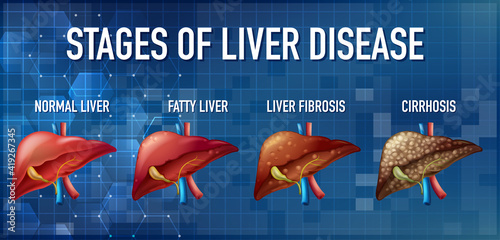 Stages of liver disease leading to Cirrhosis