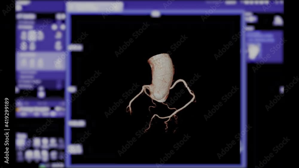 CTA Coronary artery 3D rendering image turn around on the screen for ...