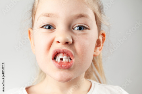 The first children's tooth fell. Portrait of a child girl with a hole in the teeth,