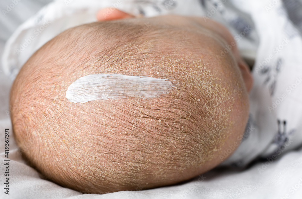 Seborrheic dermatitis on baby's head with cream on it. treatment of