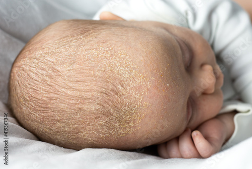 seborrheic dermatitis crusts on the baby's head. child with seborrhea in the hair photo