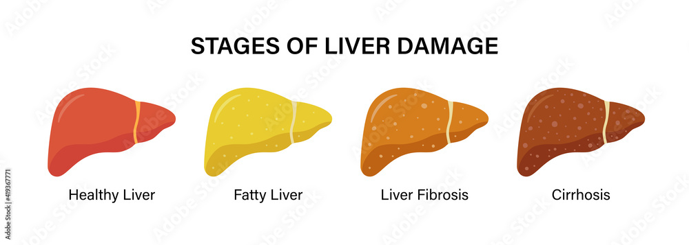 Stages of nonalcoholic liver damage. Healthy, fatty, fibrosis, cirrhosis. Liver Disease. Isolated vector illustration in flat style on white background