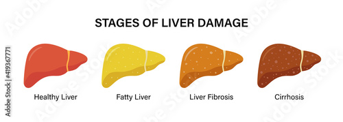 Stages of nonalcoholic liver damage. Healthy, fatty, fibrosis, cirrhosis. Liver Disease. Isolated vector illustration in flat style on white background
