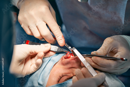 Rhinoplasty men, the surgeon's gloved hands hold the instruments during nose surgery. Doctor in gloves holds a medical instrument during rhinoplasty