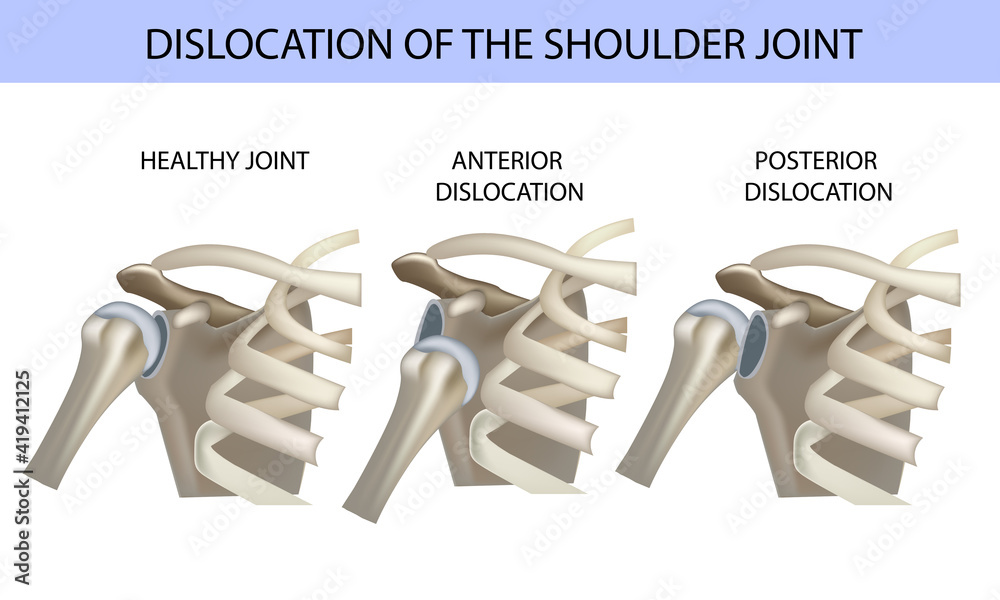 Dislocation of the shoulder joint, medical vector illustration Stock ...