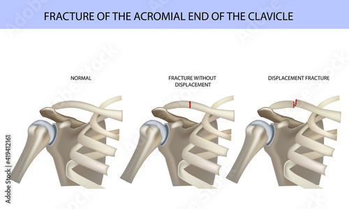 Fracture of the acromial end of the clavicle, medical vector illustration