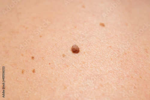 Skin tag or acrochordon or soft fibroma or mole in male back, macro view. Papilloma virus or bump, dermatology problem skin concept. 