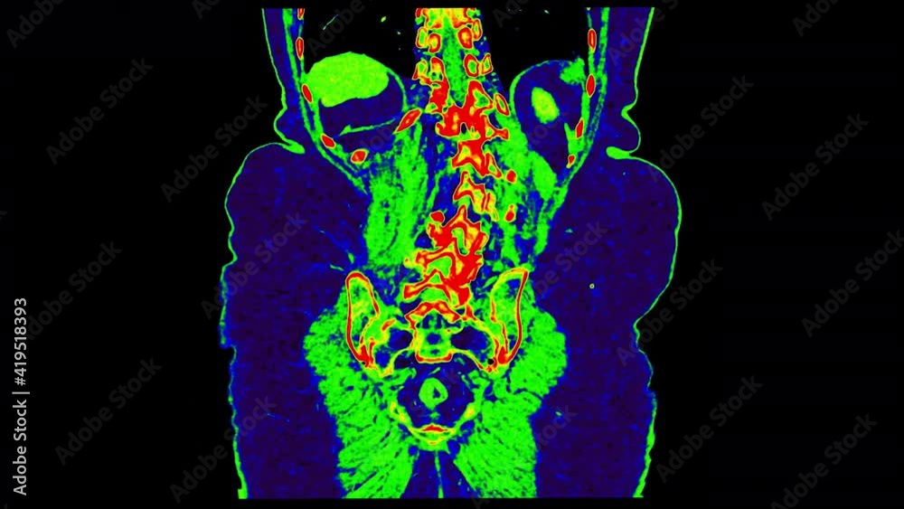 PET CT ( Positron Emission Tomography ) of whole human body 3d ...