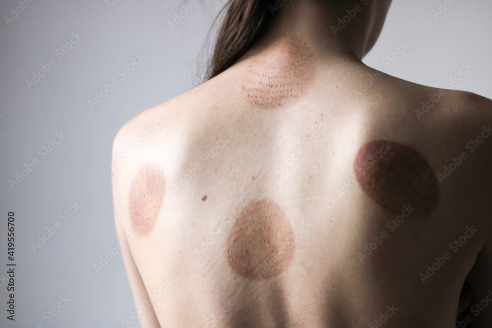 Fototapeta premium A young girl showing a scar from a hijama treatment Islamic medicine