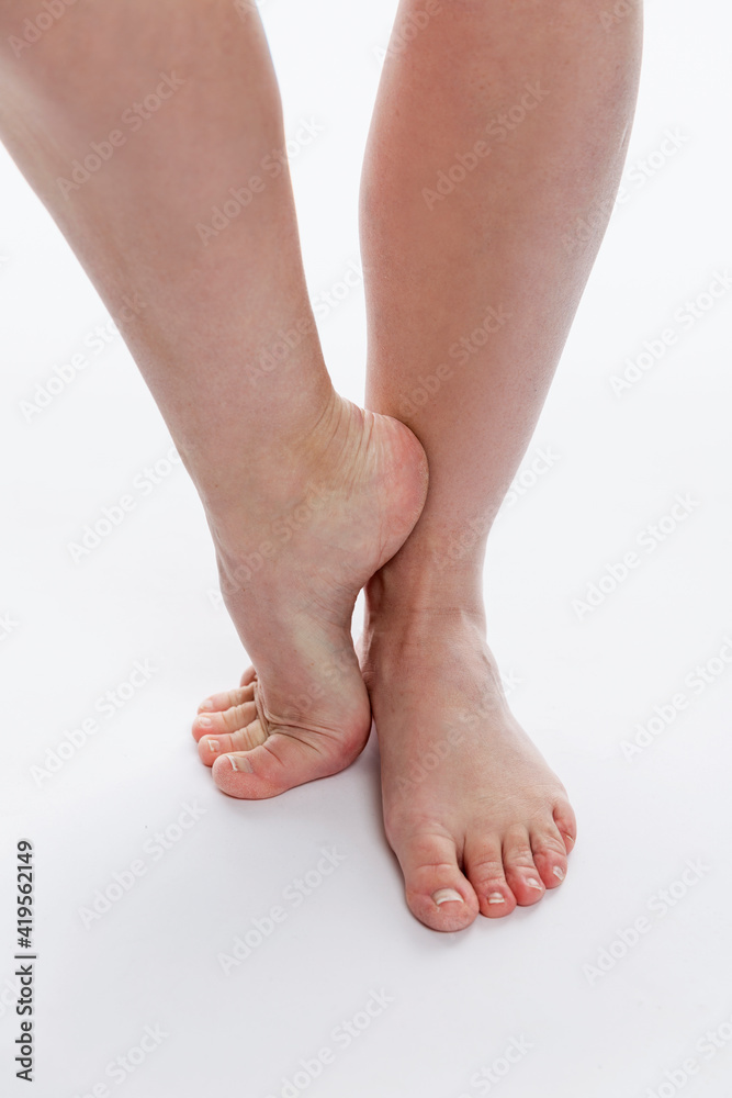 Imperfect female legs below the knees. Vascular problems. Close-up. White background. Vertical. Imperfect female legs below the knees. Vascular problems. Close-up. White background. Vertical.