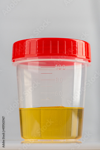 Labotatory container with human urine for medical test