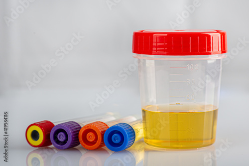 Labotatory container with human urine for medical test