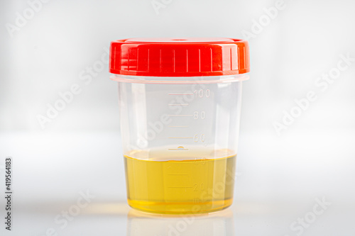 Labotatory container with human urine for medical test