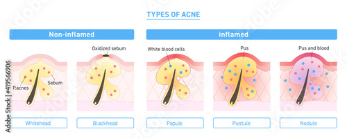 Illustration of types of acne with explanation