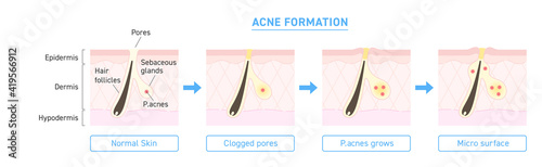 Illustration of acne formation with explanation