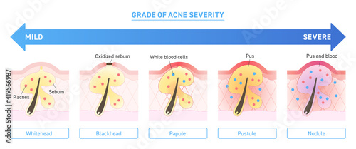 Illustration of grade of acne severity