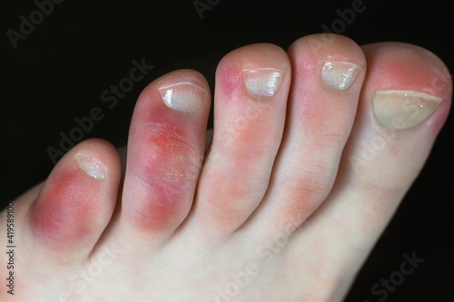 Covid toes. Coronavirus symptoms - swelling and discoloration, purplish color, pain and rough skin. photo