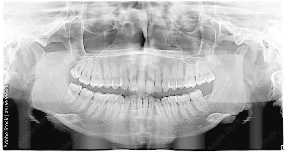 Panoramic x-ray of teeth. With wisdom teeth. Malocclusion. Panoramic x-ray of teeth. With wisdom teeth. Malocclusion.