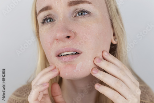 A woman examines dry skin on her face. Peeling, coarsening, discomfort, skin sensitivity. Patient at the appointment of a dermatologist or cosmetologist. Close-up of pieces of dry skin photo