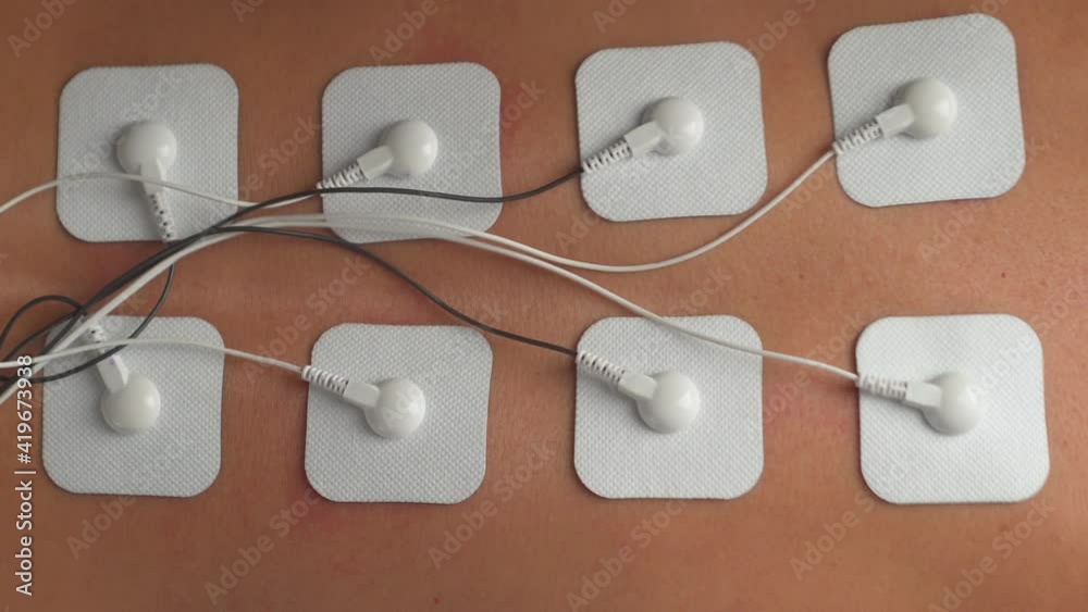 Physiotherapy of the back using electricalstimulation TENs of