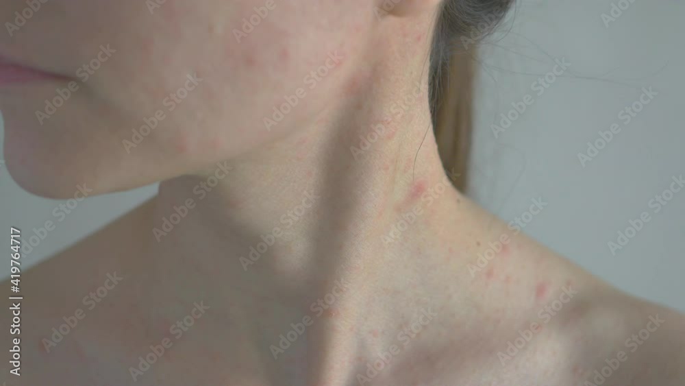 On the face and in the neck, women are strewn with allergic reactions