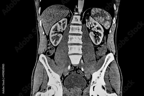 CT SCAN of abdomen showing liver, kidney and the spine. Medical themes.
