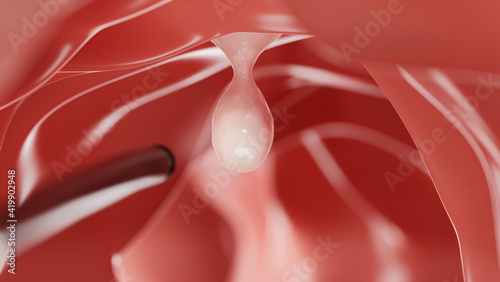 Konstfotografi Colon Polyp scan for Removal